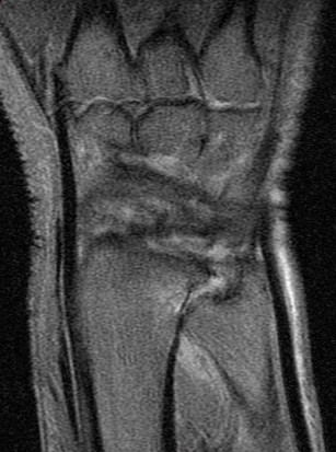 Figure 3 for case Ulnar impingement syndrome